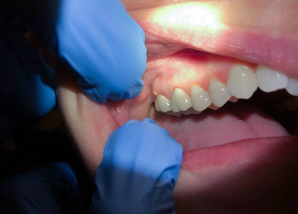 Best Chipped Tooth Repair Near Me  in Campton Hls, IL